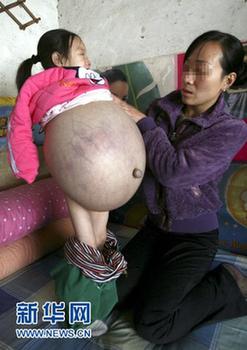 山西4歲女孩患恐怖腹水腫腹大如球 今赴京醫(yī)病