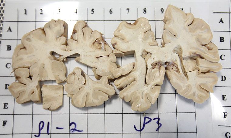 揭秘大腦解剖全過程