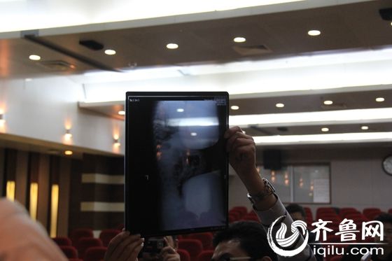 聊城針扎女嬰預計一周內康復 醫生建議關注心理問題