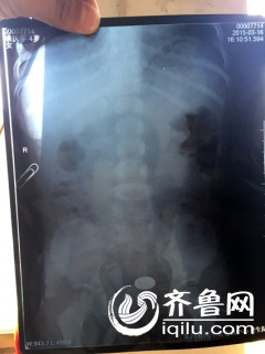 聊城：幼兒園四歲女童吞下硬幣 學(xué)生家長(zhǎng)遭遇圍毆