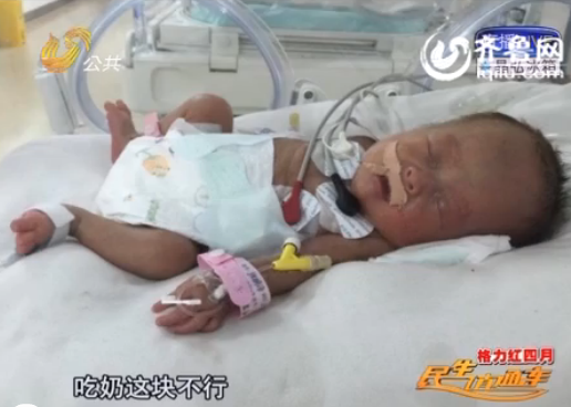 菏澤四胞胎中二女兒遭遇醫(yī)學難題 腦軟化已影響吃奶