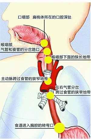 男子魚刺卡喉身亡 醫生: 吞飯喝醋等土方法更要命