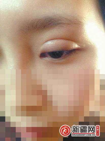 烏魯木齊一女孩割雙眼皮后腫了9個月