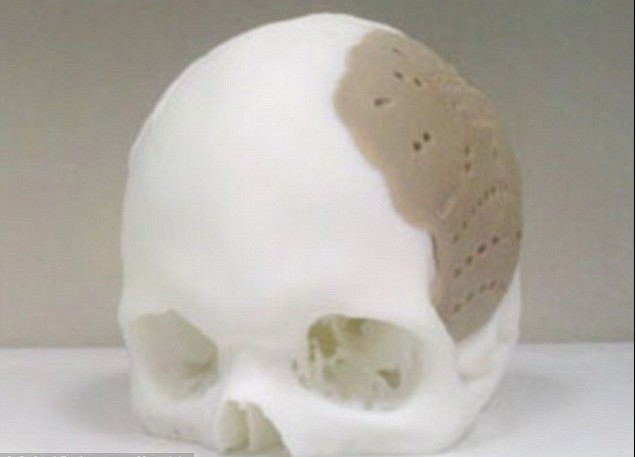 頭骨也能打??！美公司用3D打印技術造福移植患者