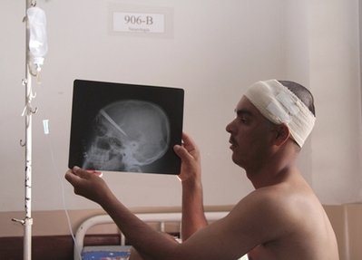 巴西男子腦中插10厘米刀刃3年 “玩命”手術(shù)成功