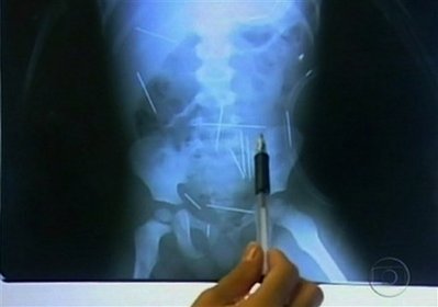 Doctors airlift boy with 42 needles stuck in him